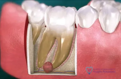 Киста зуба: основные причины и способы лечения — Клиника Лукашука