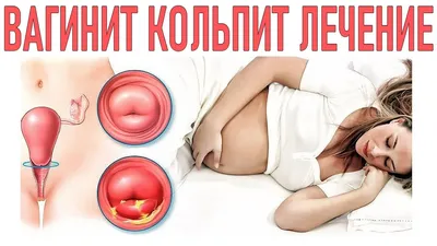 Кольпит: причины, симптомы и лечение