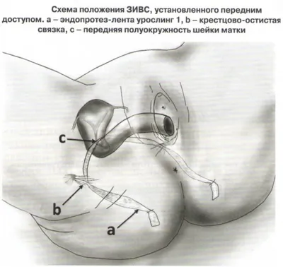 Опущение стенок влагалища и матки: безоперационное и хирургическое лечение  | Frau Klinik - клиника пластической хирургии и косметологии