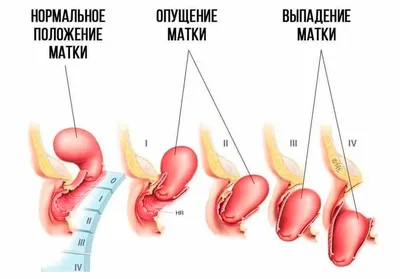 Урология: Пролапс органов малого таза - диагностика и лечение в СПб, цена