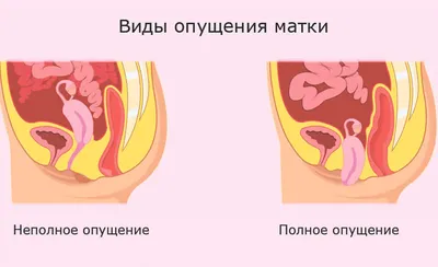 ≡ Пластика шейки матки в Киеве ᐈ Клиника Добрый прогноз