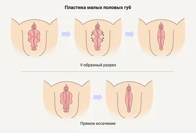 Вагинопластика (пластика влагалища, кольпорафия): цены, фото, где сделать |  Интернет-журнал Estetmedicina.ru