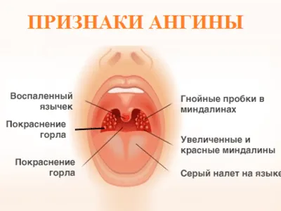 Папилломатоз гортани – причины, симптомы, диагностика и лечение | «Будь  Здоров»