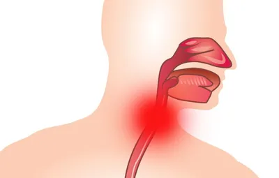 Папилломы в горле — симптомы и лечение состояния — клиника «Добробут»