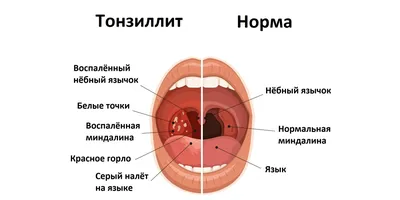 Сыпь На Корне Языка Прыщи Ближе к Горлу ЛюмиДент