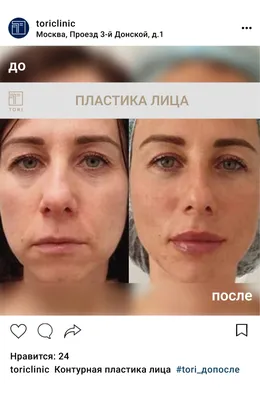 АЭМ - Контурная пластика: заполнение морщин гелями на основе гиалуроновой  кислоты, увеличение губ