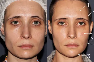 Aesthetic_med_cosmetology - Губы — Ваше эффектное преображение! До  новогодней суеты осталось совсем немного… ☝🏻😌 На фото результат  наполнения губ гиалуроновой кислотой и коррекция формы. Контурная пластика  губ может убрать мелкие заломы, восстановив