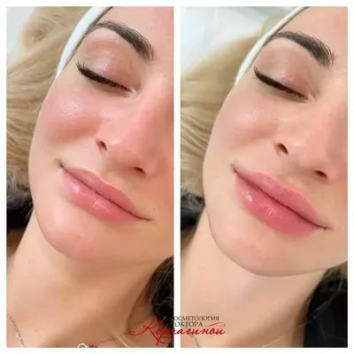 Контурная пластика лица и губ в Самаре – цены в салоне Lady Style