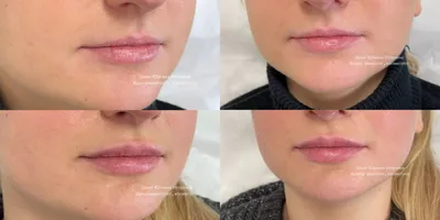 Идеальные губы изменение формы и увеличение объема