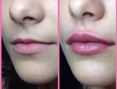 Увеличение губ до и после | Ботокс губы, Губы, Увеличение губ