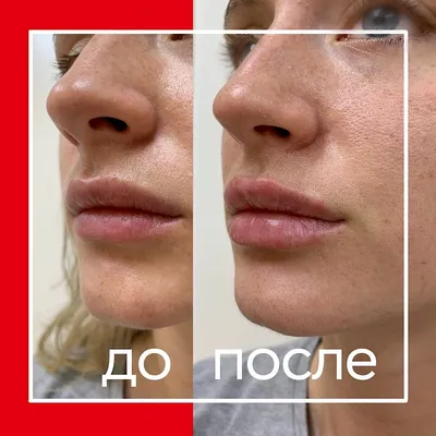 Инъекции препаратом Juvederm Ultra 3 (Ювидерм Ультра 3) - клиника лазерной  косметологии в Москве