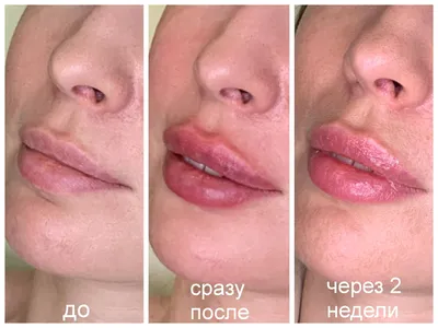 Фото до и после контурная пластика губ