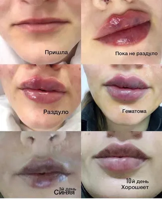 Пластика губ Кессельринг в Москве - цены в Damas Clinic | Стоимость  пластики губ