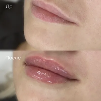 Увеличение губ гиалуроновой кислотой в Москве: цена процедуры | Увеличить  губы | Контурная пластика губ в клинике