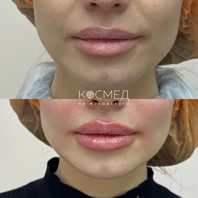 Увеличение губ в центре Киева (м. Крещатик, м. Осокорки) - цены на  увеличение губ в Laser Health