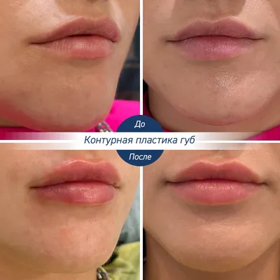 Контурная пластика губ в Москве: цена процедуры, фото до и после, отзывы |  Стоимость коррекции контура губ филлерами в клинике Seline