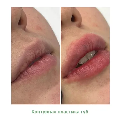 Увеличение губ филлерами гиалуроновой кислоты в Москве