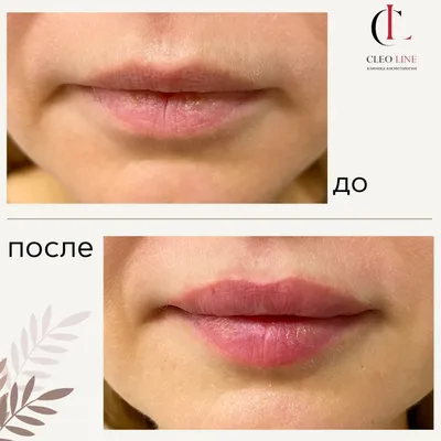 Lips beautification | Контурная пластика губ 💥Увеличение губ со скидкой до  50%! Сделайте свои губы еще более соблазнительными и… | Instagram