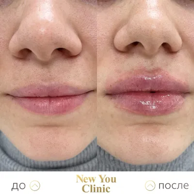 Контурная пластика губ препаратом Art Filler Lips