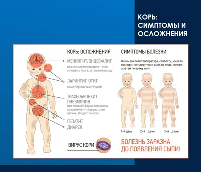 Эпидситуация по кори: не доводить до осложнений, подчищать и наверстывать -  Индустриальная Караганда