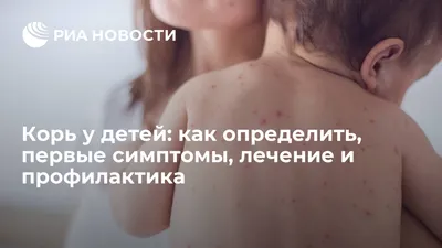 ЧЕМ ОПАСНА КОРЬ И КАК ЗАЩИТИТЬСЯ ОТ ИНФЕКЦИИ?