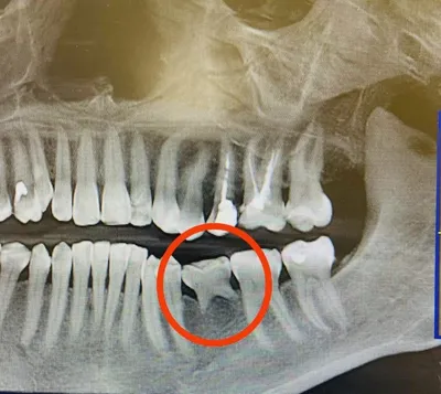 Корень молочного зуба фото фотографии