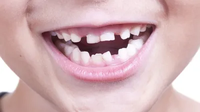 Когда следует удалять молочные зубы | NeoLifeDental