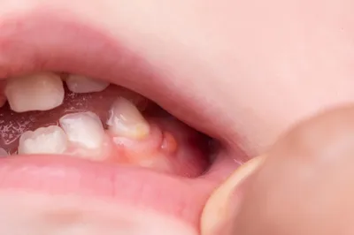 Периодонтит молочного зуба: можно ли вылечить? - Евромед Дентал