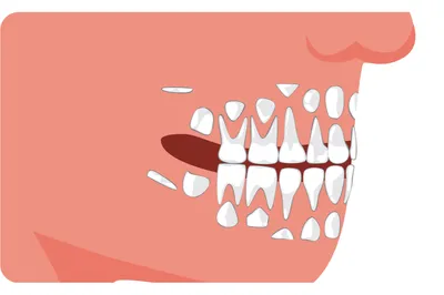 Всё про молочные зубы у детей: когда и как они выпадают? —  Стоматологическая клиника \"ЖЕМЧУГ\" г. Серов