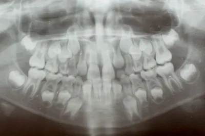 Молочные зубы у… взрослого! Стоматологический казус: что делать?