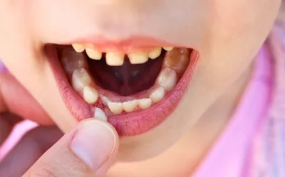 Что делать если передние молочные зубы не выпадают в 7 лет, а новые растут