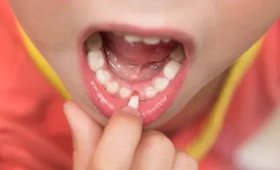 Лечение пульпита молочных зубов