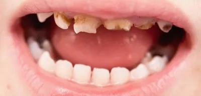 Молочные зубы у детей: схема смены и анатомия молочных зубов у ребенка -  основные методы ухода за первыми зубками