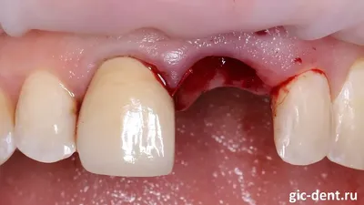 Размер зубов – норма и отклонение