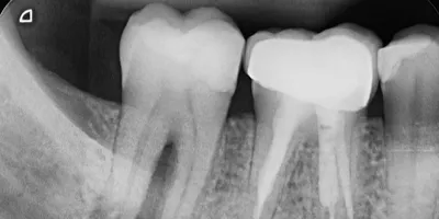 Как восстановить зуб если остался только один корень | Альянс  бьюти-ортопедов, Москва
