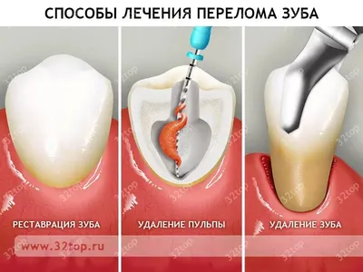 Молочные зубы и сохранение места в зубном ряду © - YouTube