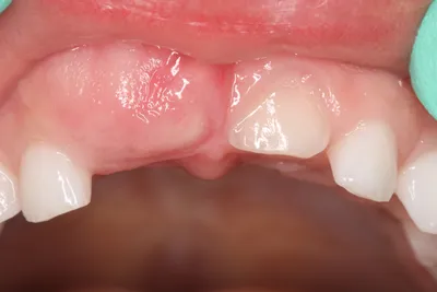 Советы специалиста: Устранение дефектов развития зуба