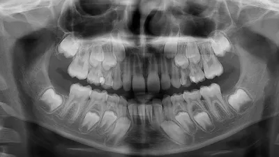 Удаление молочных зубов | Стоматология \"Ле Дент\"