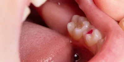 ᐈ Потемнение зуба у ребенка: почему случается и что делать