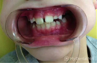 Сломан корень молочного зуба | Детская и семейная стоматологическая клиника  \"Белая Медведица\" | Санкт-Петербург