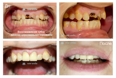 Циркониевая коронка на зуб в городе Раменское - «New Smile»