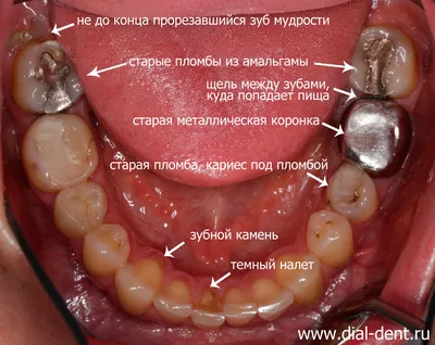 Клинический случай зубного протезирования из диоксида циркония