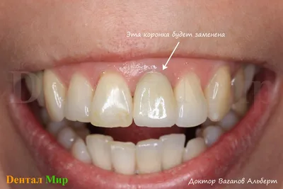 Циркониевые Коронки Цена Киев Поставить На Зубы ЛюмиДент