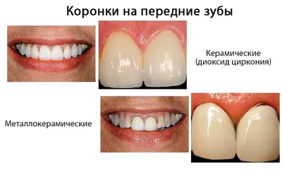Циркониевые коронки из диоксида циркония на зубы в Йошкар-Оле