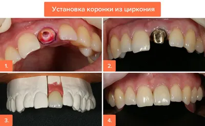Дантист-Профи - Циркониевые зубные коронки в Пскове