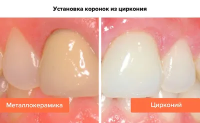 Поставить коронки из диоксида циркония на передние зубы в ТОП1 клинике  Москвы - Немецкий Имплантологический Центр