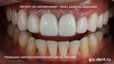 Надежные коронки из циркония (циркониевые зубы)