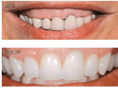 Циркониевые коронки в Туле - самые современные и красивые коронки из  диоксида циркония