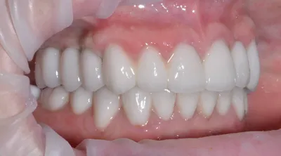 Коронки из циркония - коронка на имплант цирконий - цирконий в стоматологии  коронки