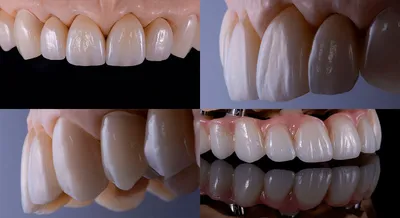 Коронки для зубов в Самаре по цене от 2.500 до 16.000 ₽